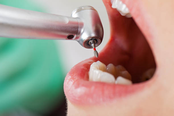 Best Knocked-Out Tooth Emergency  in Euharlee, GA
